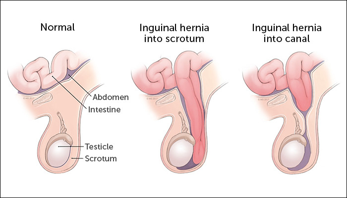 Hernia Skrotalis